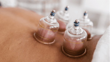 Image for 25-min Cupping Treatment by Registered Acupuncturist